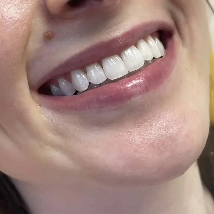 Professional WHITEsmile FLASH saloon tooth whitening