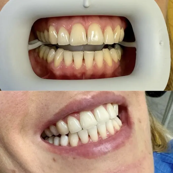 HOW IS DENTAL WHITENING CARRIED OUT?