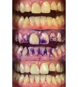 Csupán egyetlen Irányított Biofilm Terápia kezelés után lesznek ilyen ragyogóan tiszták a fogaid! ✨🦷
Fájdalommentesen, kíméletesen – mégis elképesztően hatékonyan.

Ez a kezelés nemcsak esztétikai kérdés. A biofilm eltávolítása kulcsfontosságú a fogínygyulladás, a fogszuvasodás és a fogágybetegségek megelőzésében. 🔬🪥

Te is megérdemled, hogy egészséges, tiszta és szép mosollyal élhess. Gyere el, és tapasztald meg a különbséget!

@emsdental @emsdental_hu 🩷

Just one professional Guided Biofilm Therapy session can make your teeth this sparkling clean! ✨🦷
Gentle, pain-free – yet incredibly effective.

This treatment is more than just aesthetics. Removing the biofilm is essential in preventing gum inflammation, tooth decay, and periodontal disease. 🔬🪥

You deserve to live with a healthy, clean, and beautiful smile. Come and experience the difference!

#guidedbiofilmtherapy #GBT #dentálhigiénia #dentálhigiénikus #fogtisztítás #irányítottbiofilmterápia #dentalsalon #dentalsalonbudapest #dentalsalonbyhenriett #fogkő #fogkőeltávolítás #tudatosszájápolás #egészségesmosoly #megelőzés #fogászat #fogaszat #budapestfogászat #fogorvosirendelő #tisztafogak #oralhealthcare #dentalcleaning